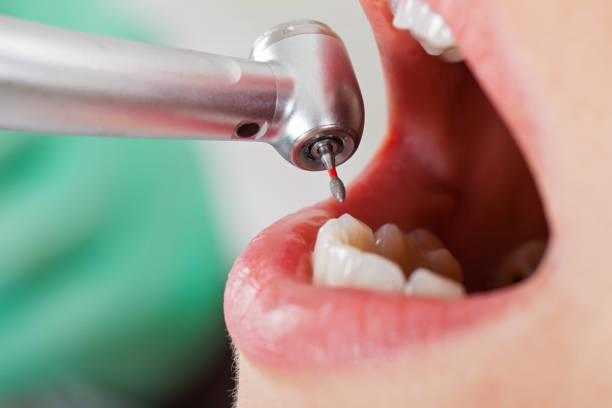 Best Emergency Root Canal Treatment in Durant, OK